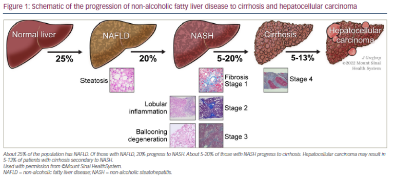 Resmetirom: An Orally Administered, Small-molecule, Liver-directed, β ...